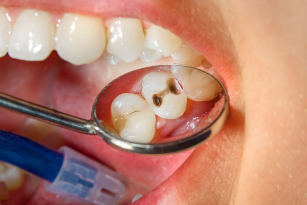 Пломбирование зубов: когда требуется повторная процедура и как этого избежать?