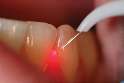 Какое отбеливание зубов лучшее?