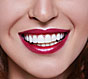 Виниры для зубов: лучший способ быстро вернуть красоту улыбки