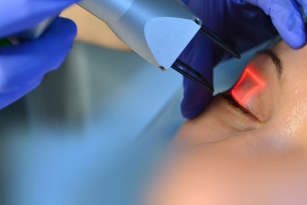 Лазерная блефаропластика век – безопасное омоложение лица без операции