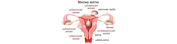 Лікування маткової міоми