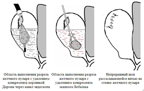 Способ лапароскопического эндоскопически ассистированного удаления конкремента через дно желчного пузыря