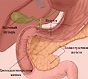 Выводы. Литература. Панкреатит - хирургическое лечение