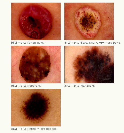 Диагностика и удаление новообразований кожи