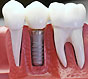 Имплантация зубов и ее особенности