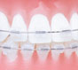 Детская стоматология: особенности сапфировых брекет-систем