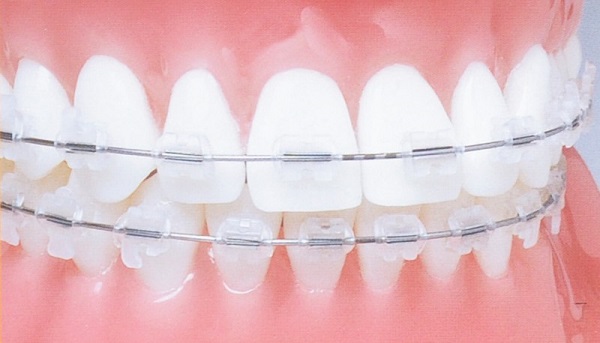 Детская стоматология: особенности сапфировых брекет-систем