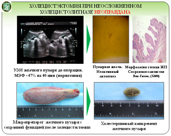 Через 2 мес после лапароскопической холецистэктомии отмечалось развитие раннего функционального постхолецистэктомического синдрома