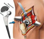 Эндопротезирование тазобедренного сустава: показания, ход операции, стоимость