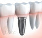 Современная имплантация зубов в стоматологии Дент Лайн