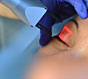 Лазерная блефаропластика век – безопасное омоложение лица без операции
