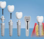 Почему врачи-стоматологи рекомендуют протезирование зубов на имплантах?