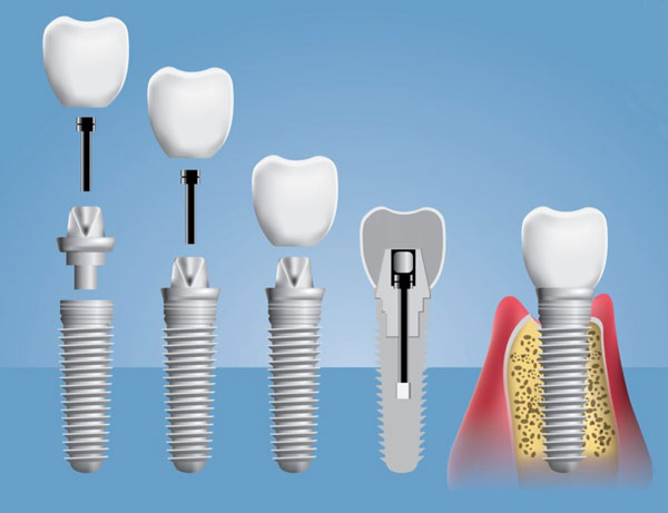 Почему врачи-стоматологи рекомендуют протезирование зубов на имплантах?