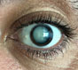 Симптомы, лечение и последствия катаракты