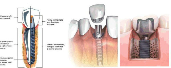  Імплантати можна назвати корінням зубів, але тільки штучним. title=