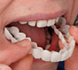 Керамічні вініри на передні зуби
