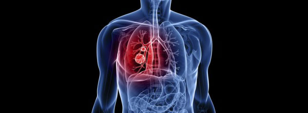 Рак легень – причини, симптоми, діагностика, лікування