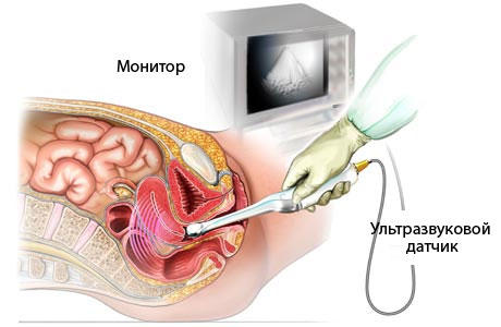 Піхвовий УЗД органів малого таза