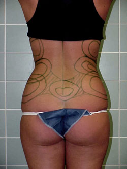 Ультразвукова ліпосакція