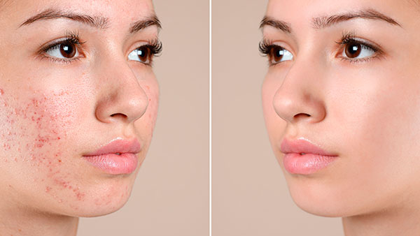 Проблемна юнацька та жирна шкіра Проблемна юнацька та жирна шкіра