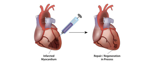 Відновлення пошкодженого міокарда після інфаркту