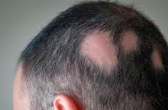 Очаговая алопеция: роль иммунитета и аутоиммунные механизмы Очаговая алопеция: роль иммунитета и аутоиммунные механизмы