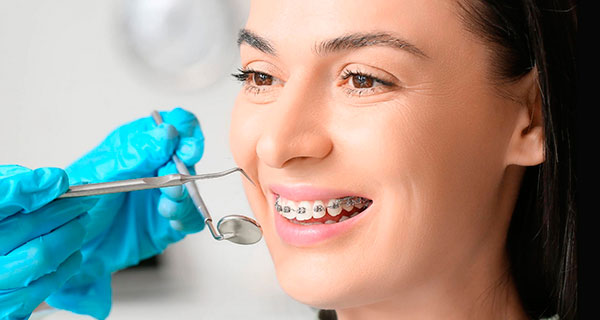 Цены на брекеты и элайнеры в Днепре