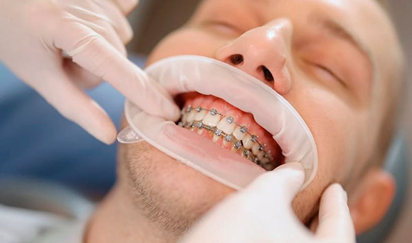 стоимость установки брекетов в Днепре